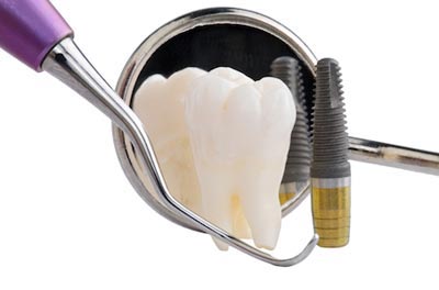 tools used for dental implants