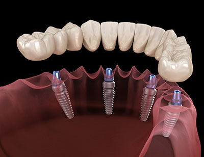 diagram of All-on-X dental implants