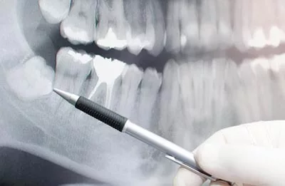 dentist reviewing an x-ray of wisdom teeth