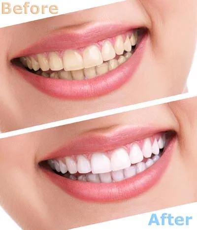 before and after shot of Opalescence teeth whitening offered at Family Dental of Spokane Valley